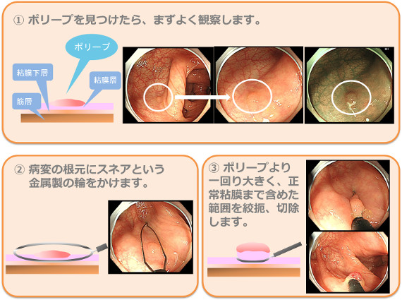 後 大腸 性行為 切除 ポリープ