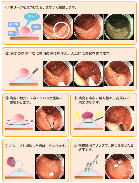 ポリープ 切除 大腸