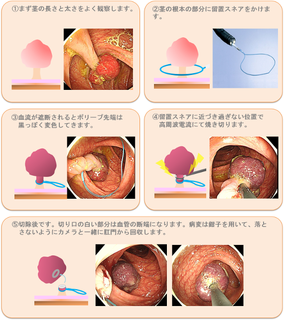 留置スネア