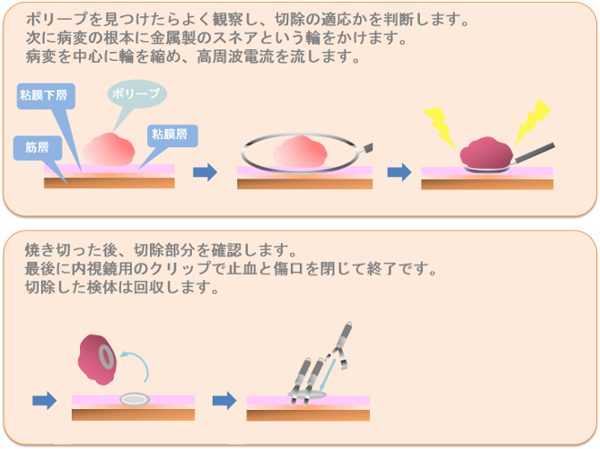 ポリープ 切除 大腸 大腸ポリープは何ミリから切除する？なりやすい食事はあるの？