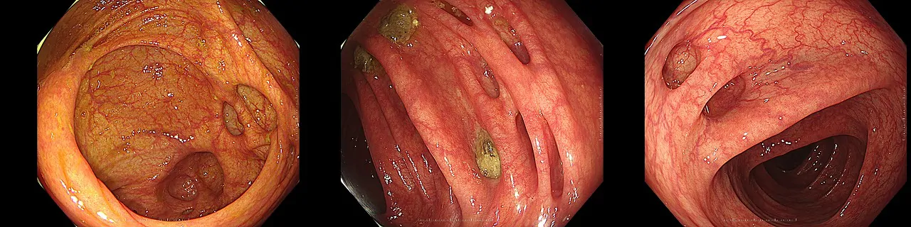 大腸憩室症