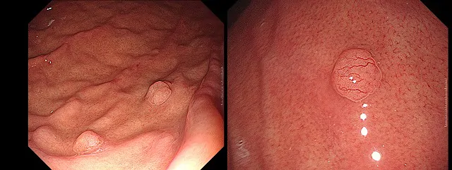胃底腺ポリープ