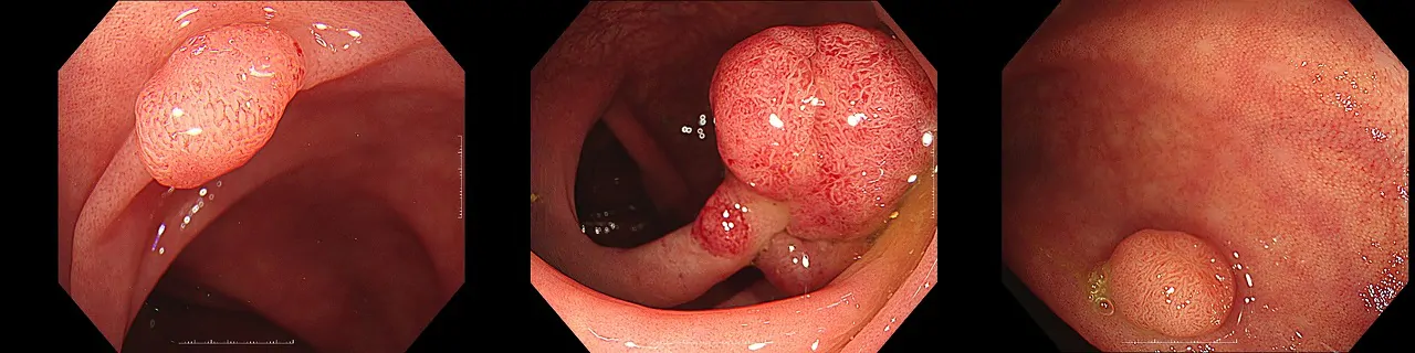 大腸腺腫（大腸ポリープ）