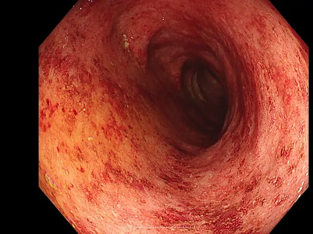 潰瘍性大腸炎