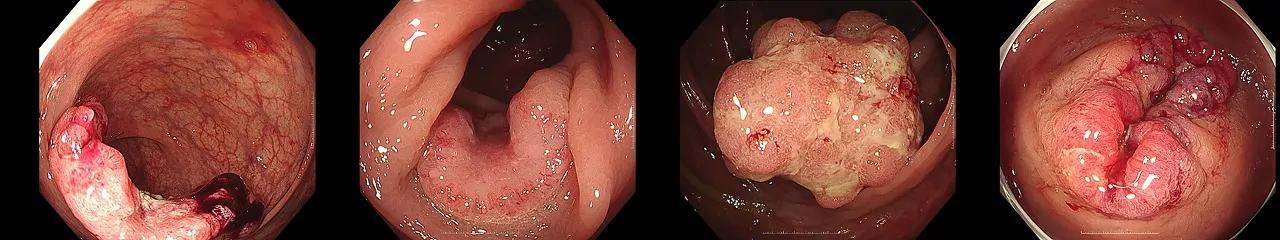 進行大腸がん