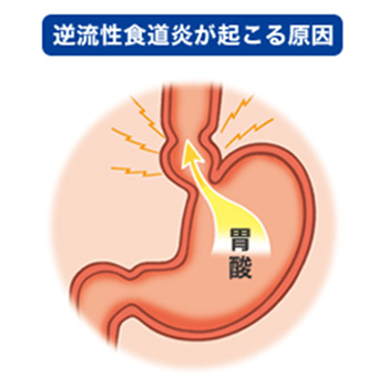 逆流 性 食道 炎 発熱