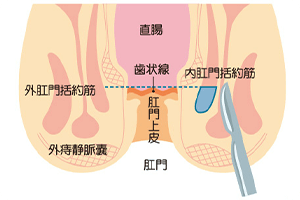 側方皮下内括約筋切開術（LSIS）