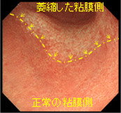 萎縮した粘膜側、正常の粘膜側